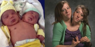 Twins That Share One Body